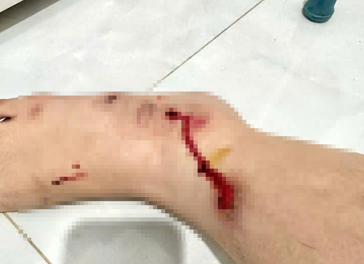 Cướp giật điện thoại, kéo lê nạn nhân trên đường một đoạn dài