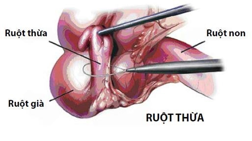 Dấu hiệu điển hình khi viêm ruột thừa