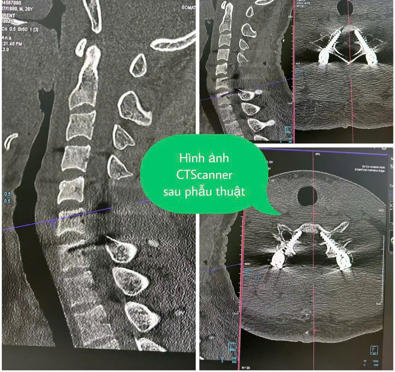 Phẫu thuật thành công cho người nước ngoài bị chấn thương cột sống cổ nặng