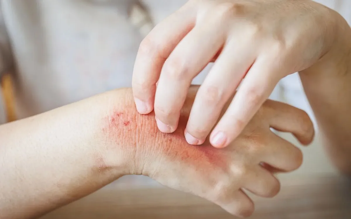 Cách nhận biết và phòng tránh bệnh da thường gặp mùa hè