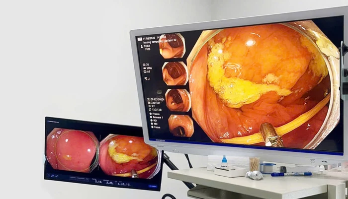 Nội soi lấy thành công tăm tre đâm thủng ruột non của bệnh nhân