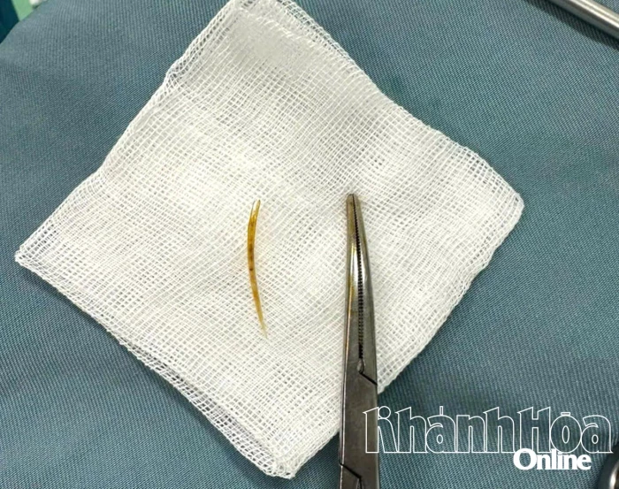 Gắp thành công dị vật đâm thủng ruột non cho bệnh nhân