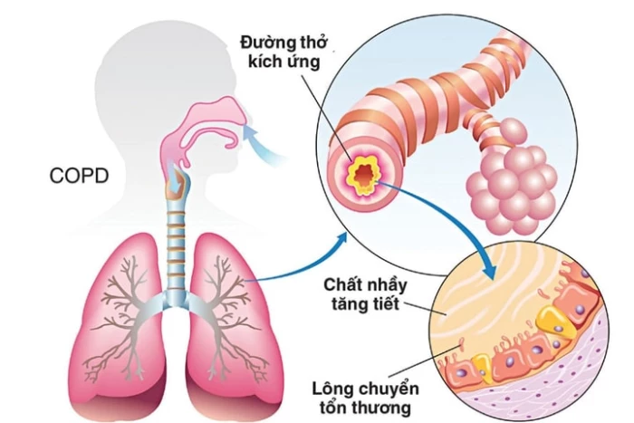Phòng ngừa, phát hiện sớm bệnh phổi tắc nghẽn