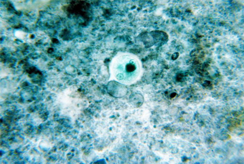  Đơn bào Entamoeba histolytica