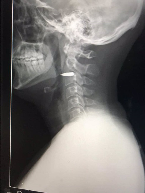 Hình ảnh X-quang cho thấy viên đạn găm vào phần cổ nhà báo Adam Harvey. Ảnh: ABC News