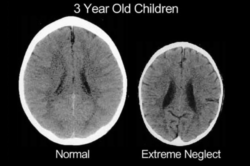 Não của trẻ bình thường (trái) và trẻ bị bỏ mặc. Ảnh: ChildTrauma Academy.