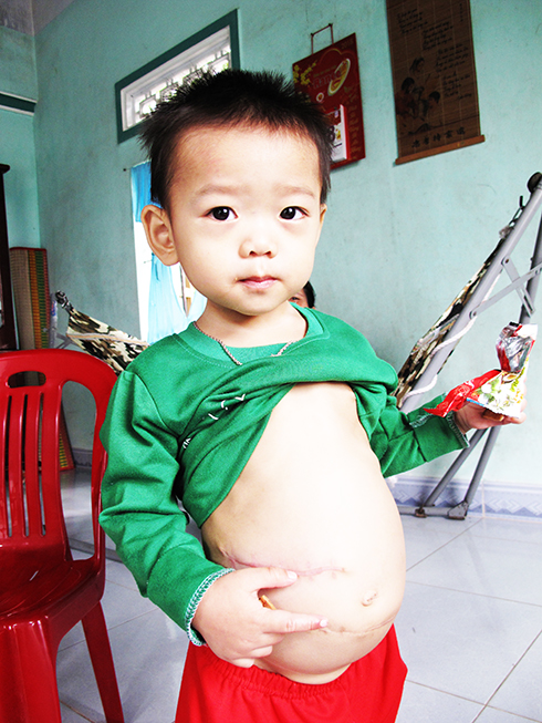 Bé Phan Tuấn Kiệt với nhiều vết mổ trên bụng và vai.