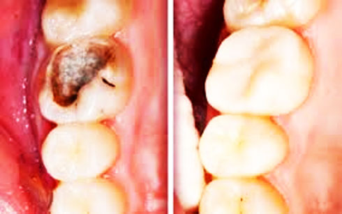 Có thể tạo ra các hợp chất kích thích quá trình khoáng hóa tự nhiên của các mô răng và khắc phục được bệnh sâu răng 