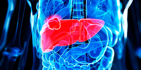 Giải pháp mới ngăn ung thư gan tái phát