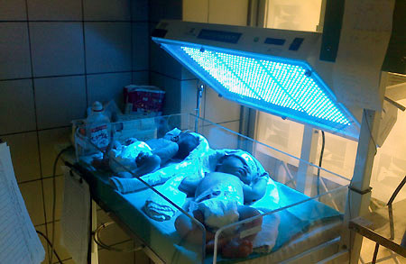 Chiếu đèn điều trị vàng da bệnh lý ở trẻ sơ sinh.