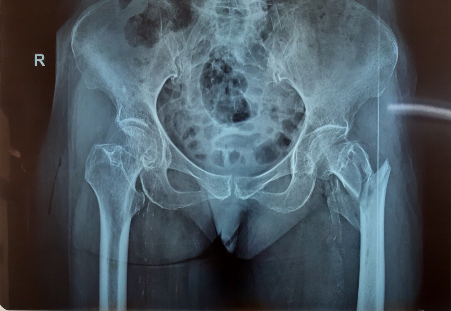 Hình ảnh chụp X-quang cho thấy liên mấu chuyển đùi trái bị gãy