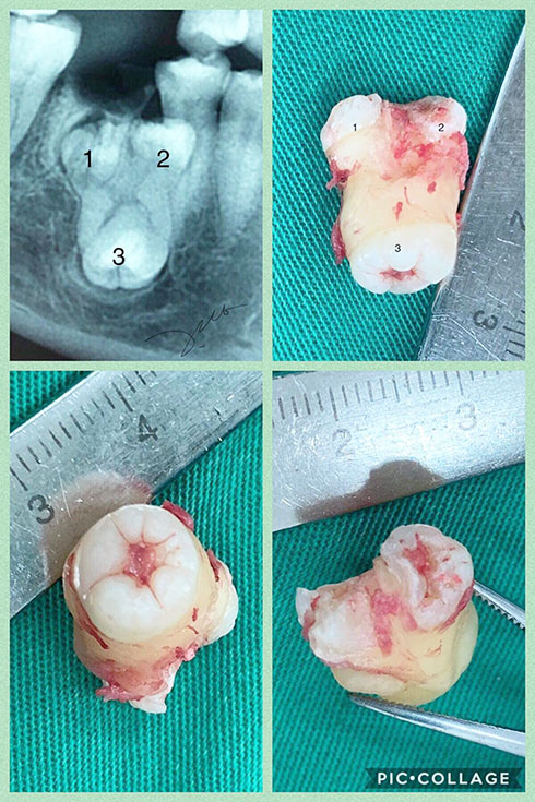 Bệnh viện Đa khoa tỉnh: Điều trị trường hợp răng sinh ba ngầm hiếm gặp