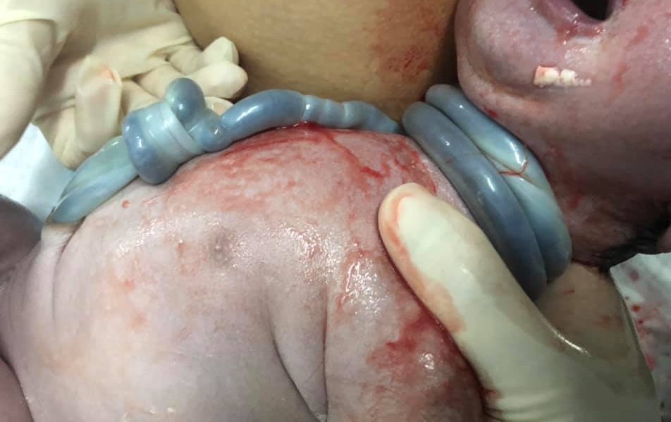 Đỡ đẻ thành công ca dây rốn vừa thắt nút vừa quấn cổ 3 vòng hiếm gặp