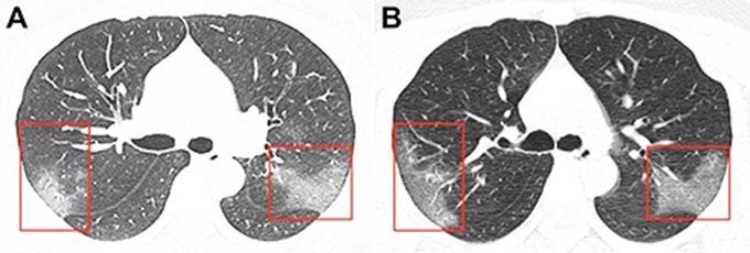  Phổi của bệnh nhân nCoV trong lần chụp đầu tiên (A) và lần thứ hai sau đó ba ngày (B).