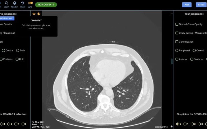 Ảnh chụp CT phổi người không mắc Covid-19. Ảnh: Detected-X.
