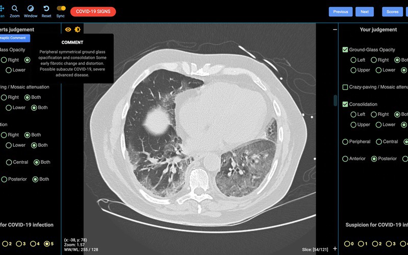 Ảnh chụp CT phổi người mắc Covid-19. Ảnh: Detected-X.