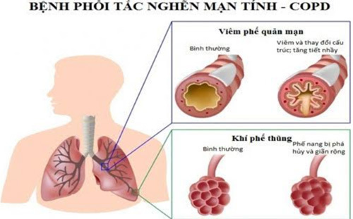 Tiếp tục Phát huy hiệu quả của mạng lưới quản lý, điều trị bệnh phổi tắc nghẽn mãn tính