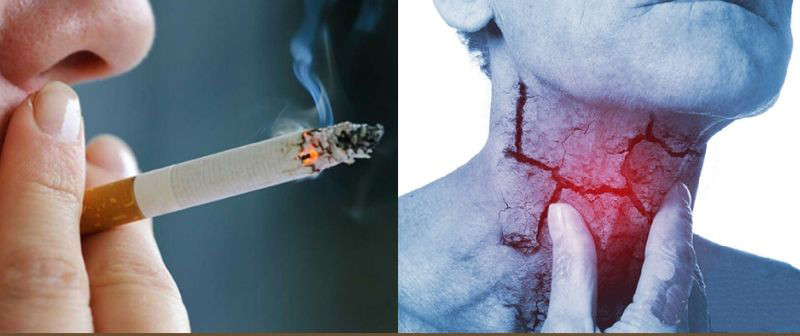 Hút thuốc lá là một trong những nguyên nhân gây ung thư vòm họng.