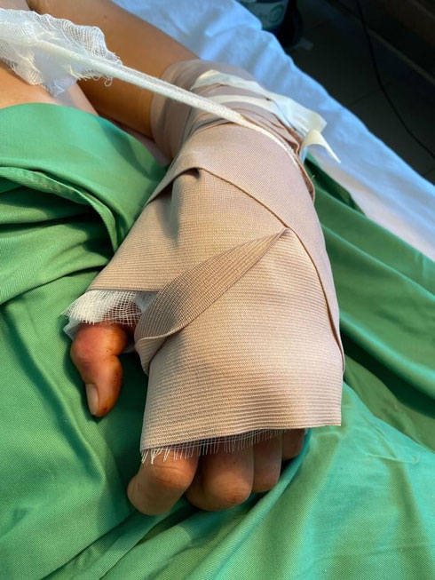 Nối thành công cổ tay đứt lìa cho bệnh nhân