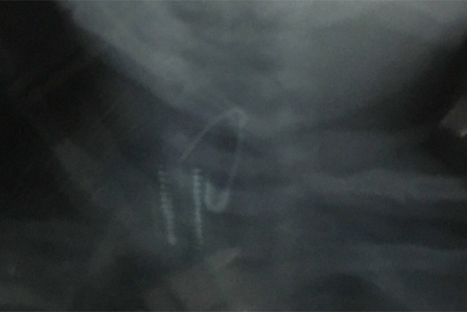 Gắp thành công kim băng mắc ở thực quản cho trẻ 18 tháng tuổi