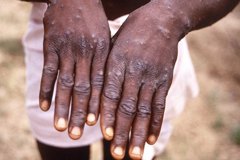 Bộ Y tế: Giám sát chặt chẽ để ngăn ngừa bệnh đậu mùa khỉ xâm nhập