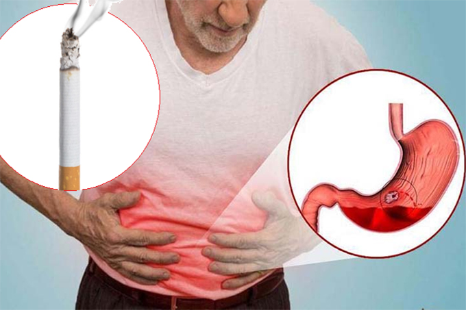 Cai thuốc lá - giải pháp phòng ngừa bệnh trào ngược thực quản