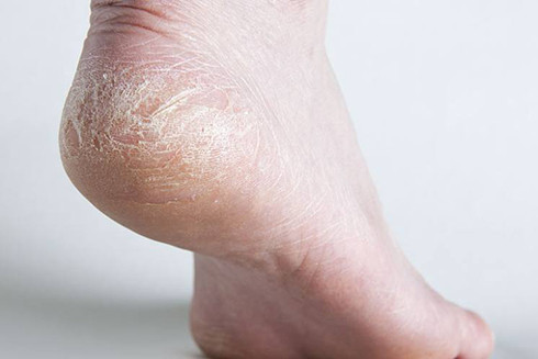 Nứt gót chân là một chứng bệnh ngoài da, thường gặp ở da khô và diễn tiến nặng hơn vào mùa hanh khô. Nguồn ảnh: Internet 