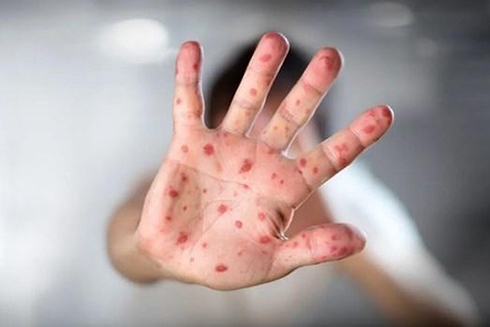 Tổ chức Y tế thế giới sử dụng tên tiếng Anh mới cho bệnh đậu mùa khỉ