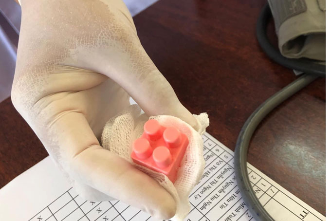 Cấp cứu gắp lấy dị vật thành công cho trẻ 9 tháng tuổi